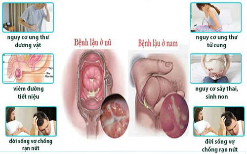 Sức khỏe, đời sống: Bệnh lậu và các biến chứng nguy hiểm của bệnh Tac-hai-cua-benh-lau