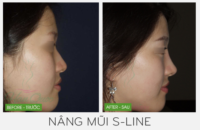 Nâng mũi s line với BS Tú Dung tại TMV JW Nang-mui-s-line-voi-bac-si-tu-dung-03