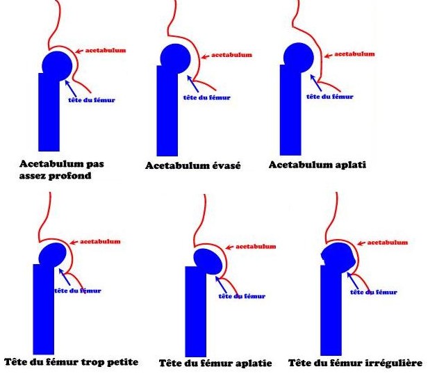 Dysplasie Coxo Femorale - Hanchesss
