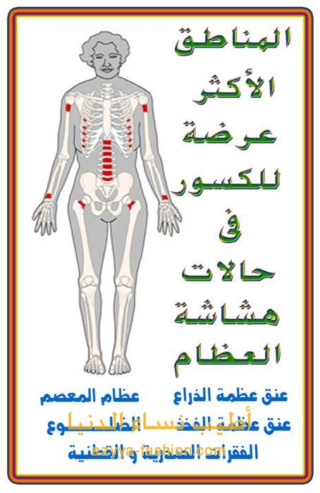 هشاشة العظام .......الوحش الصامت 10071516061763