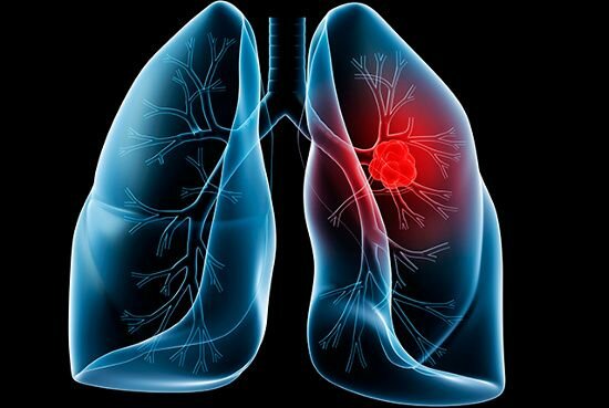 Ung Thư (K) Phổi là gì ?  Lungcancer