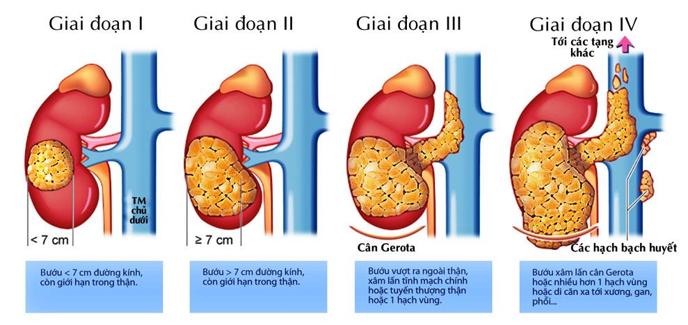 Ung thư thận và những lưu ý về bệnh Ung%20thu%20than