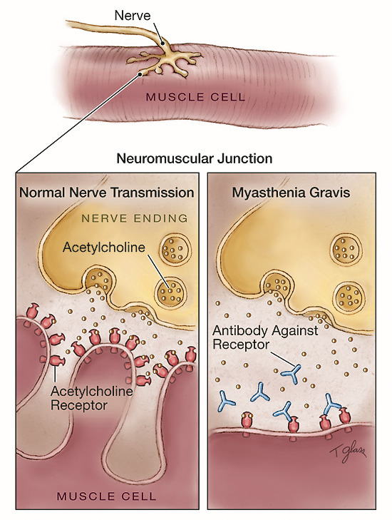 الوهن العضلي الشديد Myasthenia Gravis 79732_11244737201