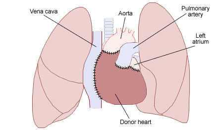 Sind die Milliarden des ESM eigentlich echtes Geld  - Seite 2 Heart_transplant