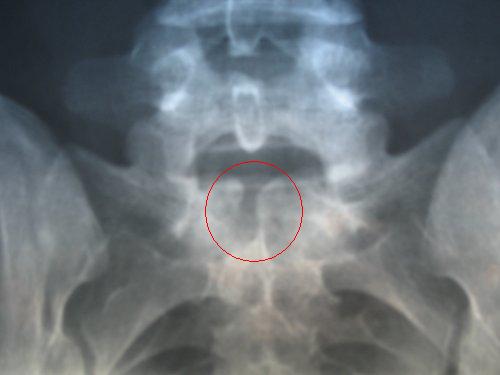 Spina bifida Spina_Bifida_pelvis_X-ray