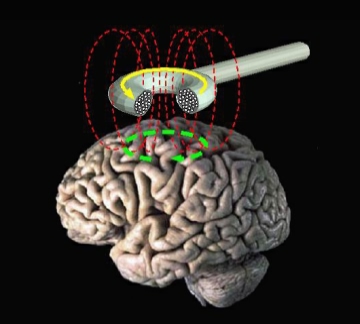 Effectiveness of Transcranial Magnetic Stimulation in Clinical Practice Post-FDA Approval Transcranial_magnetic_stimulation