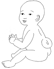 Spina bifida Spina_bifida_drawing