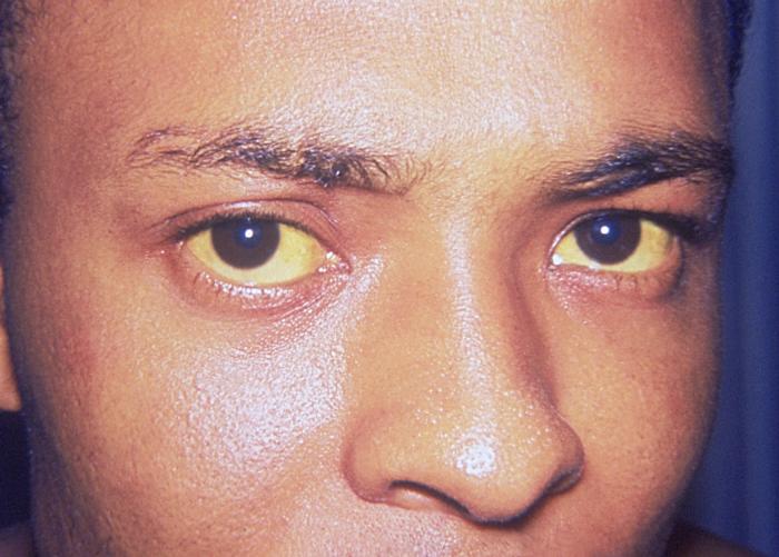 الأسبوع 1 : Jaundice Jaundice_eye