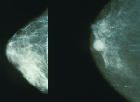 الموسوعة الشاملة للسرطان - صفحة 2 Mammo_breast_cancer