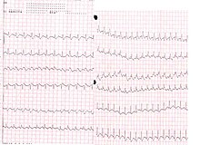 pulmonary embolism بالتفصيل 220px-Pulmonary_embolism_ECG