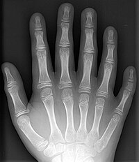 polidactilia 200px-Polydactyly_01_Rhand_AP