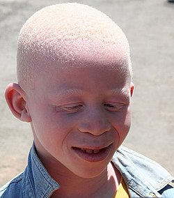 الألبينو المهَق أو البرص أو الاغراب (بالإنجليزية: albinism) (الألبينية)،  250px-Albinisitic_man_portrait