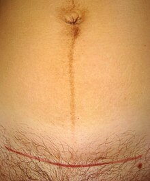 Linea Nigra 220px-Cesarean_section_scar_and_linea_nigra