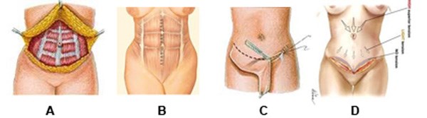 Xu hướng làm đẹp mới: Tạo hình thành bụng khỏi nỗi lo mỡ chảy xệ Tao-hinh-thanh-bung