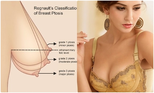 Các cách ngăn ngừa ngực chảy xệ Nang-nguc-chay-xe-tham-my-14