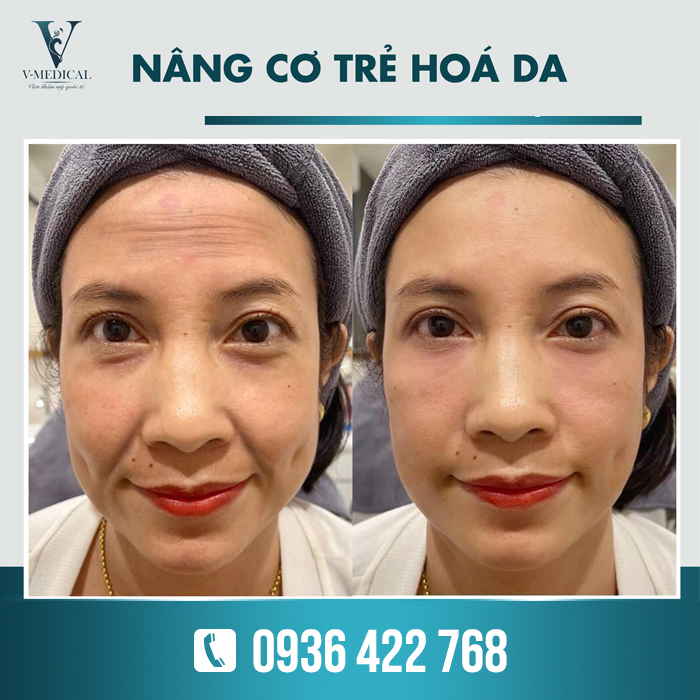 Tìm hiều về công dụng của kem nâng cơ mặt Lancome Nang-co-tre-hoa-da-1