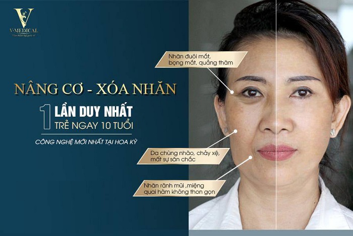 Cẩm nang làm đẹp: Cách nâng cơ mặt | Viện Thẩm Mỹ V-Medical Cach-nang-co-mat-4