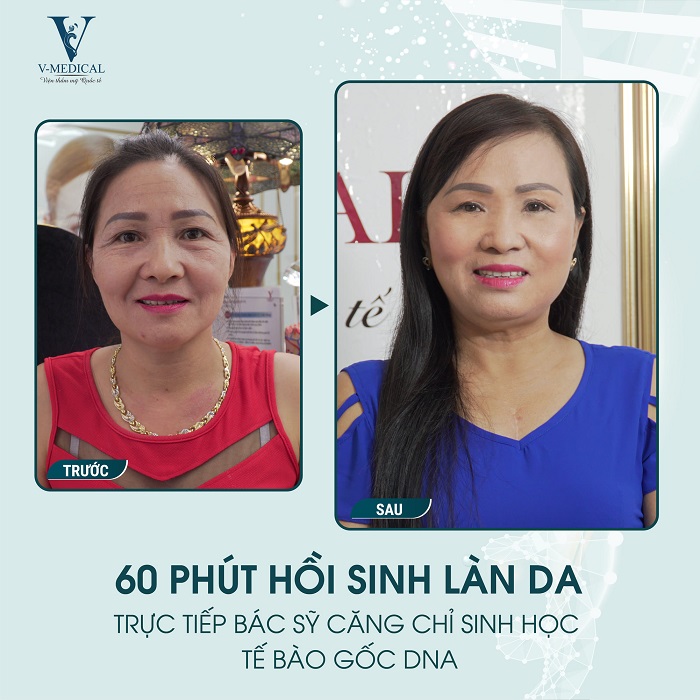 Căng chỉ nâng cơ mặt giá bao nhiêu tiền hiện nay? Cang-chi-nang-co-3