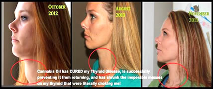 Woman Shrinks Inoperable Mass, Heals Her Thyroid Disease With Cannabis Oil Lindsay-progress-cannabis-thyroid-