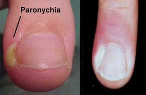 داحس الظفر: أسبابه وعلاجه.  Paronchyia 01