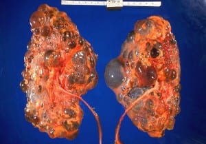 تكيس الكلى تعريف واسباب وأعراض التكيس الكلوى  Polycystic_kidneys-300x209