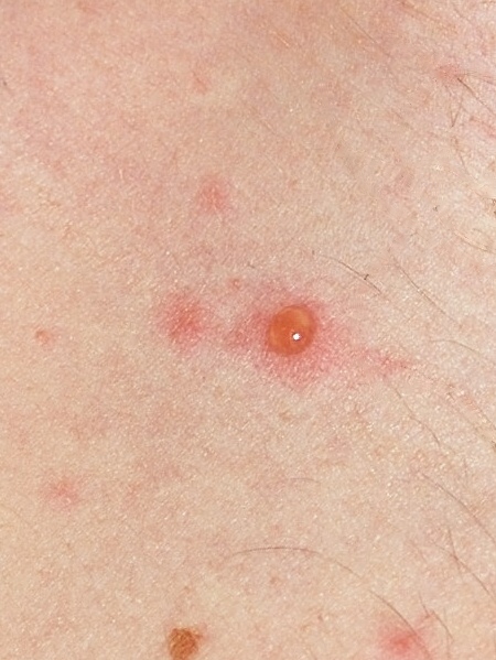 الجدري المائي- أسبابه- أعراضه- الوقاية منه- علاجه Chickenpox_blister