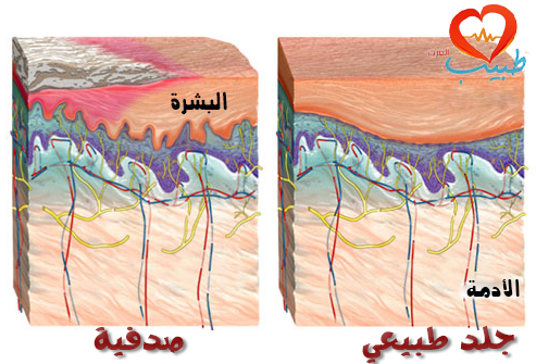 المعالجة الدوائية للصدفية ( psoriasis treatment ) %D8%B7%D8%A8%D9%8A%D8%A8-%D8%B9%D8%B1%D8%A8-%D8%AC%D9%84%D8%AF-%D8%B5%D8%AF%D9%81%D9%8A%D8%A9