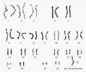 متلازمة تيرنر Turner syndrome 07_07b-Turner_syndrome-300x253