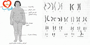 متلازمة تيرنر Turner syndrome Ts1-300x153