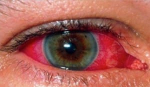 ألتهاب العنبية Uveitis Uveitis-fig2-300x174