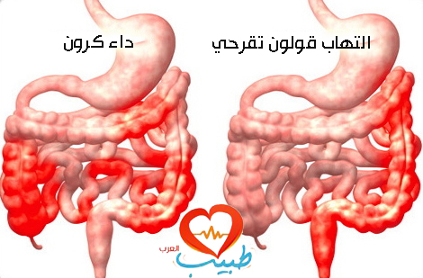 التهاب القولون التقرحي Ulcerative Colitis 111