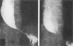 تعذر الارتخاء المريئي Achalasia Om848b-300x188