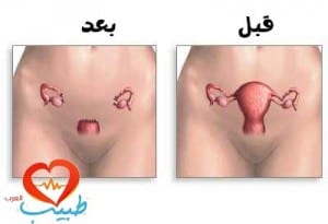 استئصال الرحم hysterectomy(أسبابه وأنواعه ومضاعفاته) %D8%B7%D8%A8%D9%8A%D8%A8-%D8%B9-%D9%86%D8%B3%D8%A7%D8%A6%D9%8A%D8%A9-%D8%A7%D8%B3%D8%AA%D8%A6%D8%B5%D8%A7%D9%84-%D8%B1%D8%AD%D9%85-1-300x205