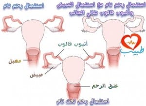 استئصال الرحم hysterectomy(أسبابه وأنواعه ومضاعفاته) %D8%B7%D8%A8%D9%8A%D8%A8-%D8%B9-%D9%86%D8%B3%D8%A7%D8%A6%D9%8A%D8%A9-%D8%A7%D8%B3%D8%AA%D8%A6%D8%B5%D8%A7%D9%84-%D8%B1%D8%AD%D9%85-300x219