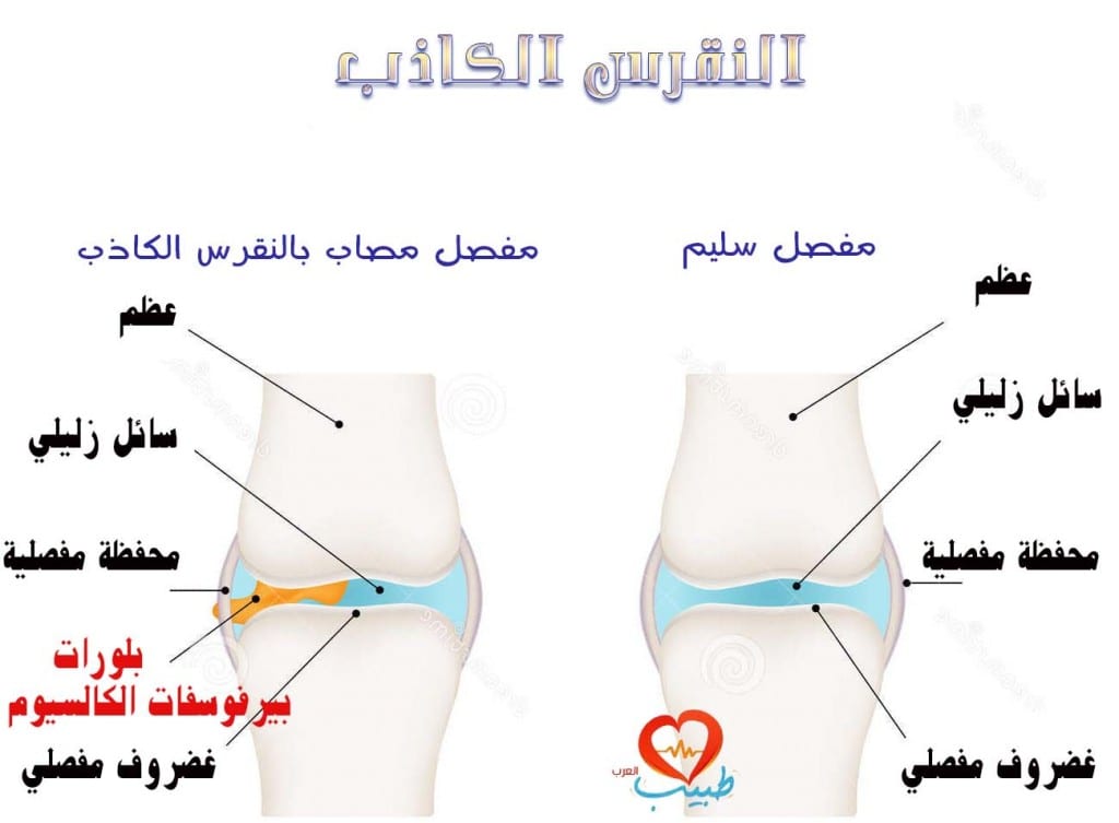 النقرس الكاذب (Pseudogout): تعريفه وأسبابه وأعراضه وعلاجه %D8%B7%D8%A8%D9%8A%D8%A8-%D8%B9%D8%B1%D8%A8-%D9%85%D9%81%D8%A7%D8%B5%D9%84-%D9%86%D9%82%D8%B1%D8%B3-%D9%83%D8%A7%D8%B0%D8%A8-1024x753