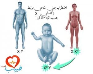 متلازمة ليش نيهان Lesch–Nyhan Syndrome %D8%B7%D8%A8%D9%8A%D8%A8-%D8%B9-%D8%A7%D8%B7%D9%82%D8%A7%D9%84-%D9%85%D8%AA%D9%84%D8%A7%D8%B2%D9%85%D8%A9-%D9%84%D9%8A%D8%B4-%D9%86%D9%8A%D9%87%D8%A7%D9%86-300x240