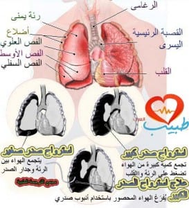 استرواح الصدر أو الريح الصدرية (pneumothorax) أسبابه وأعراضه وعلاجه %D8%B7%D8%A8%D9%8A%D8%A8-%D8%B9-%D8%AA%D9%86%D9%81%D8%B3%D9%8A%D8%A9-%D8%A7%D8%B3%D8%AA%D8%B1%D9%88%D8%A7%D8%AD-2-273x300