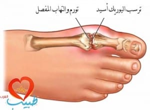 متلازمة ليش نيهان Lesch–Nyhan Syndrome %D8%B7%D8%A8%D9%8A%D8%A8-%D8%B9-%D9%85%D9%81%D8%A7%D8%B5%D9%84-%D8%AA%D8%B1%D8%B3%D8%A8-%D8%A7%D9%84%D9%8A%D9%88%D8%B1%D9%8A%D9%83-%D8%A7%D8%B3%D9%8A%D8%AF-300x221