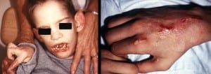 متلازمة ليش نيهان Lesch–Nyhan Syndrome Lesch-Nyhan-Syndrome-300x106