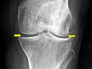 النقرس الكاذب (Pseudogout): تعريفه وأسبابه وأعراضه وعلاجه Slide1-300x225