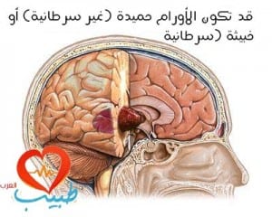 سرطان الدماغ .. أنواعه وأعراضه وعلاجه %D8%B7%D8%A8%D9%8A%D8%A8-%D8%B9-%D8%B9%D8%B5%D8%A8%D9%8A%D8%A9-%D8%A3%D9%88%D8%B1%D8%A7%D9%85-%D8%A7%D9%84%D8%AF%D9%85%D8%A7%D8%BA-300x240