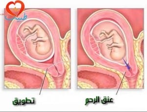 الإجهاض التلقائي: أسبابه وأنواعه وعلاجه %D8%B7%D8%A8%D9%8A%D8%A8-%D8%B9-%D9%86%D8%B3%D8%A7%D8%A6%D9%8A%D8%A9-%D8%A7%D8%AC%D9%87%D8%A7%D8%B6-%D8%B9%D9%84%D8%A7%D8%AC-300x230