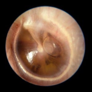 التهاب الأذن الوسطى المصلي – وجود السائل في الأذن الوسطى: أسبابه وأعراضه وعلاجه Main.php_-300x300