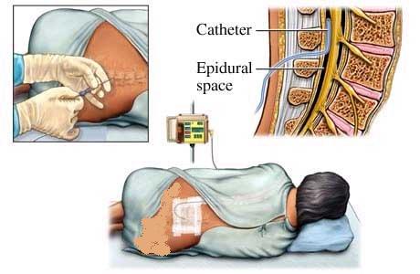 تخفيف حدة الألم خلال المخاض ( الولادة ) 01276428939