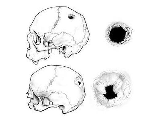 Hallan en Soria dos cráneos trepanados de la Edad Media Craneos-trepanados--478x390