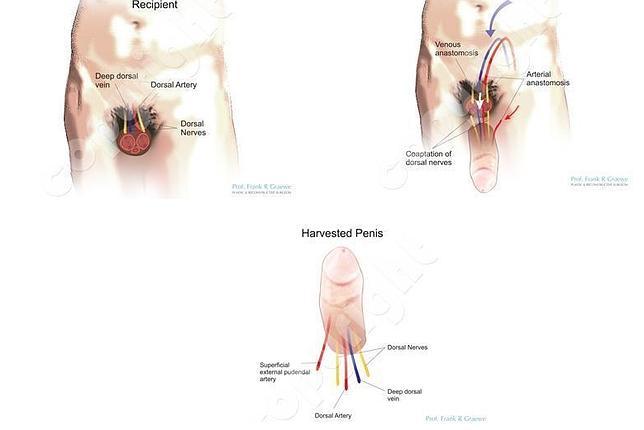 Médicos sudafricanos realizan con éxito el primer trasplante de pene del mundo Pene-trasplante-foto--644x430