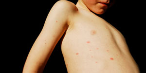 Chickenpox Chickenpox_m2070571