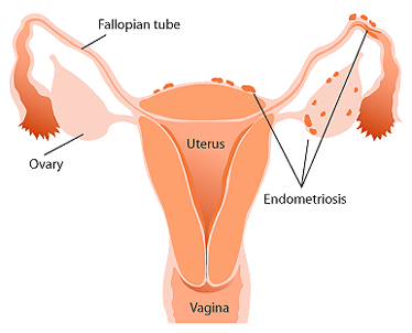 دول بعض صور الابدومن والبلفيس لسنه تانيه Endometriosis_diag