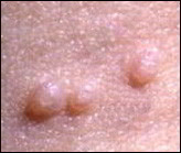 Molluscum contagiosum Molluscum-contagiosum