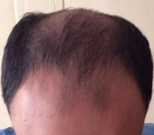 أجريت عملية زراعة شعر في مشفى دار الشفاء في تركيا  1432115221